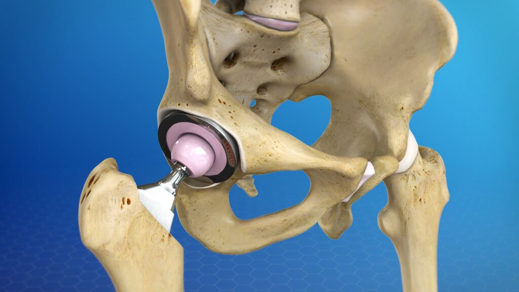 joint-replacement