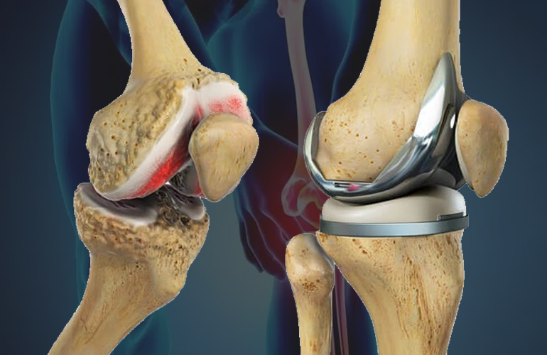joint-replacement