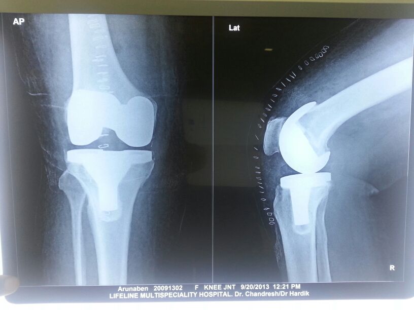 Knee replacement case 14