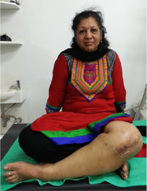 Knee replacement case 15