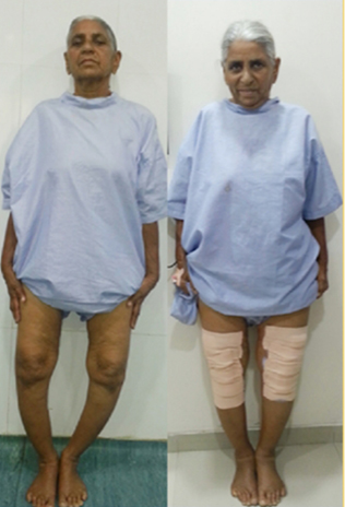 Knee replacement case 18