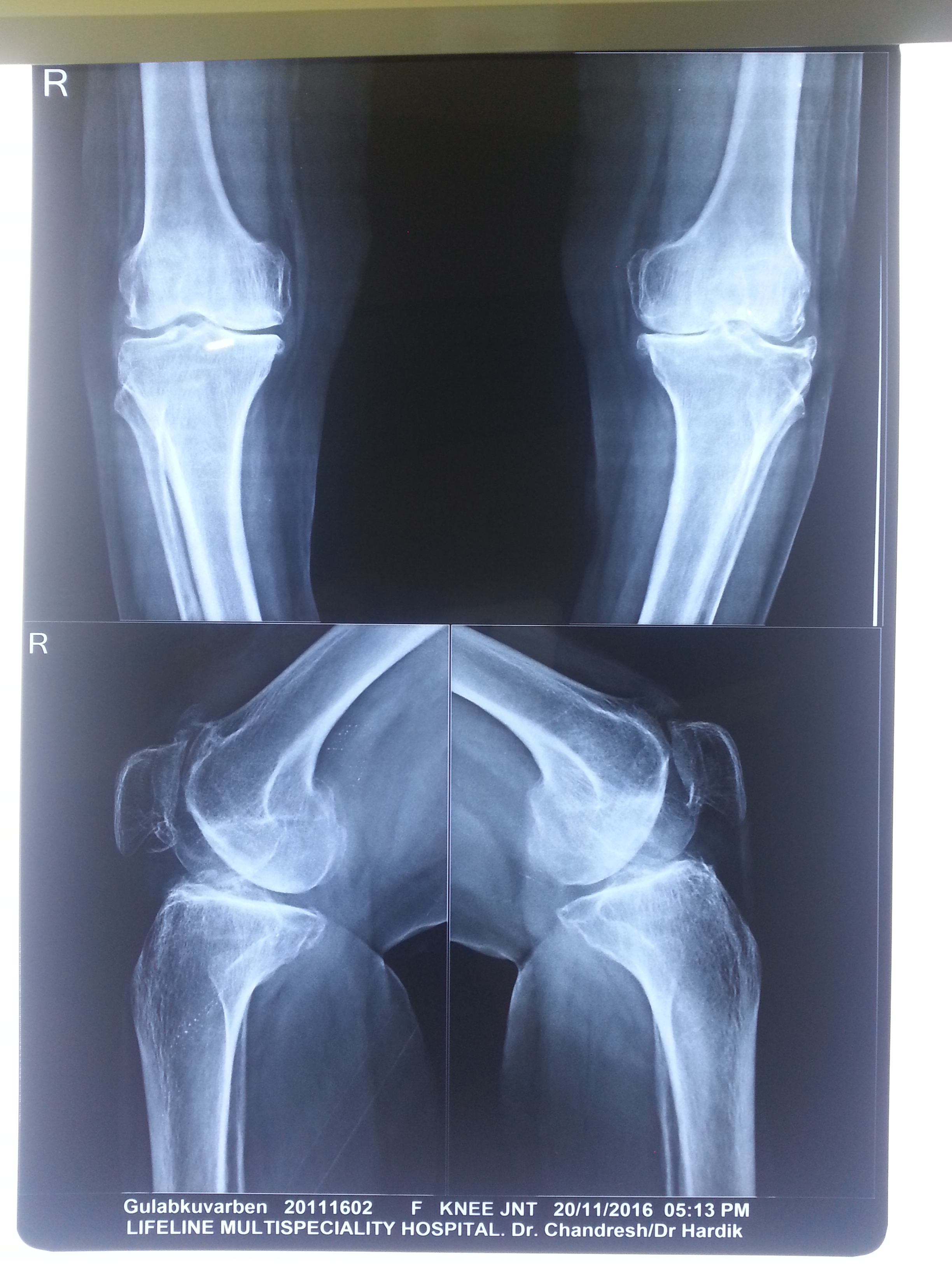 Knee replacement case 21
