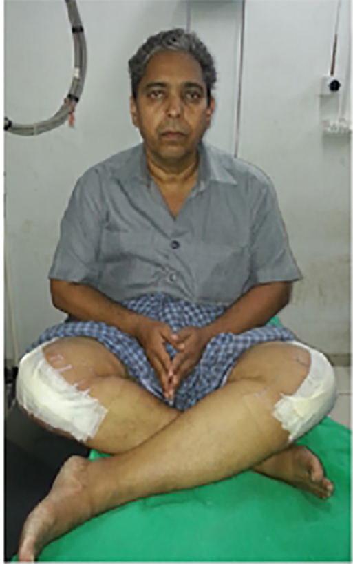 Knee replacement case 23