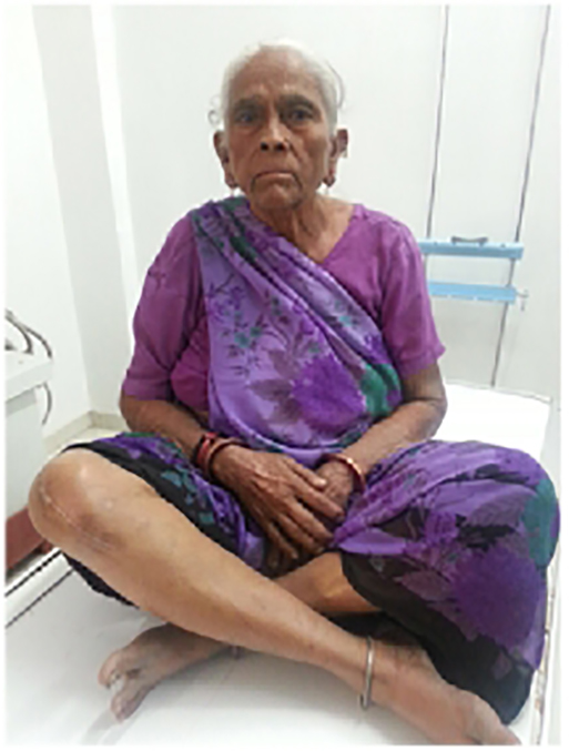 Knee replacement case 27