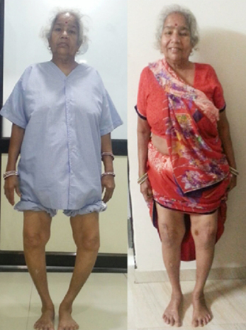 Knee replacement case 30