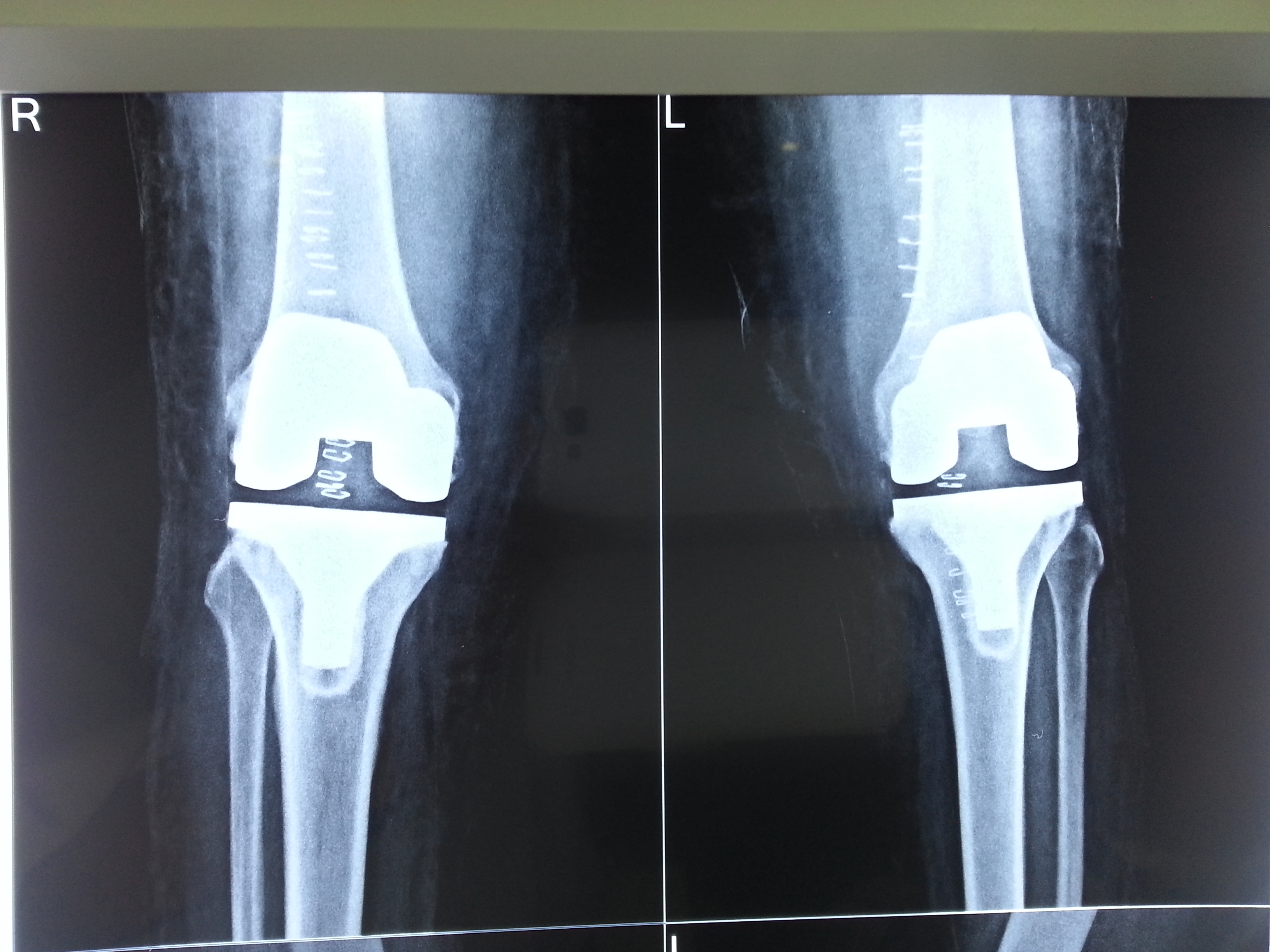 Knee replacement case 31