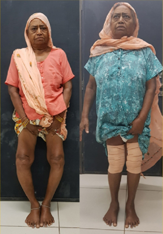 Knee replacement case 33