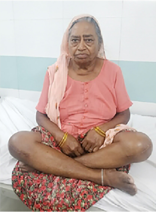 Knee replacement case 34