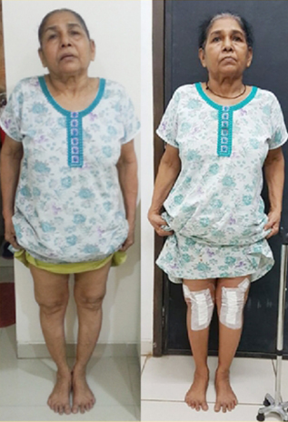 Knee replacement case 39