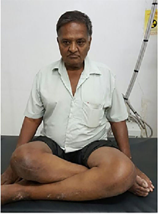 Knee replacement case 4