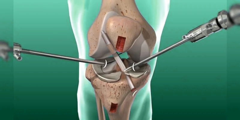 Illustration of knee arthroscopy with a camera and instruments inserted through small incisions