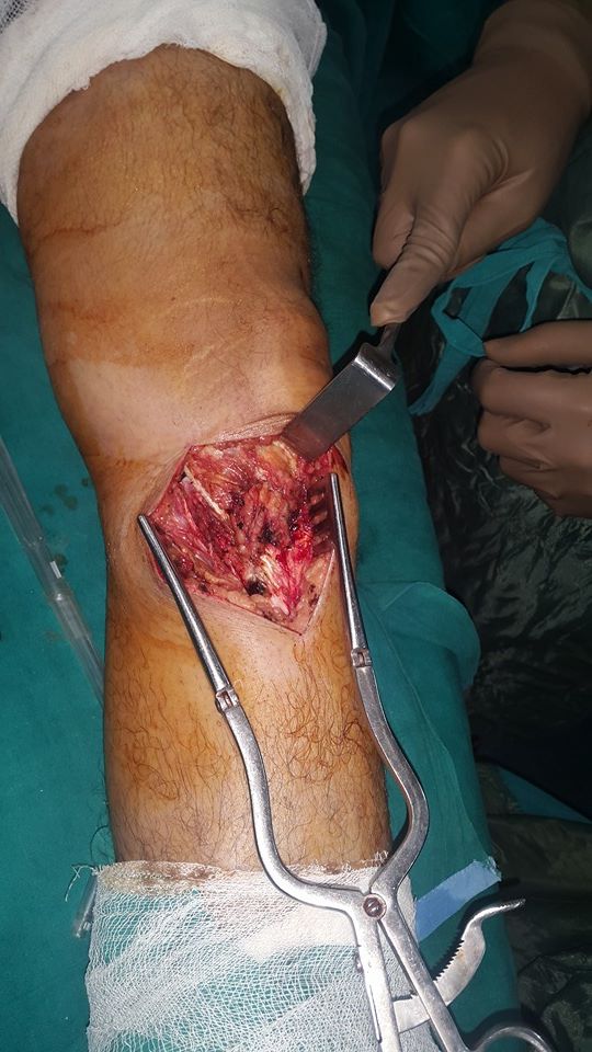 Limb salvage surgery X-ray result