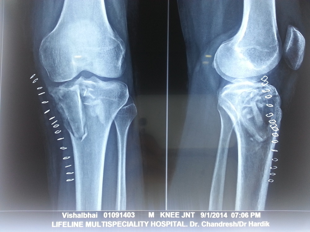 Treated bone tumour case X-ray