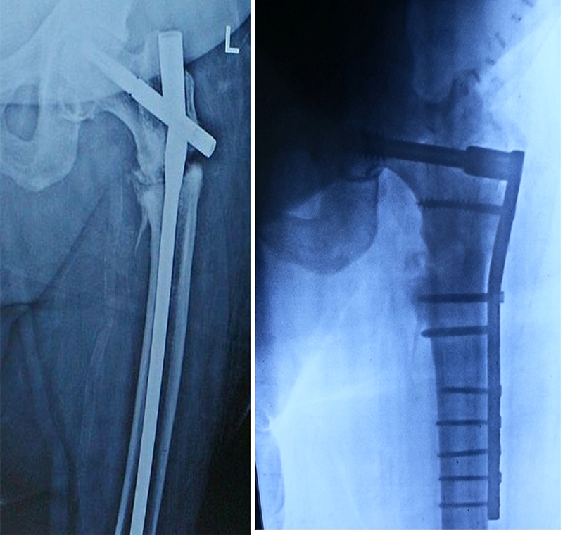 Complex fracture surgery case 10