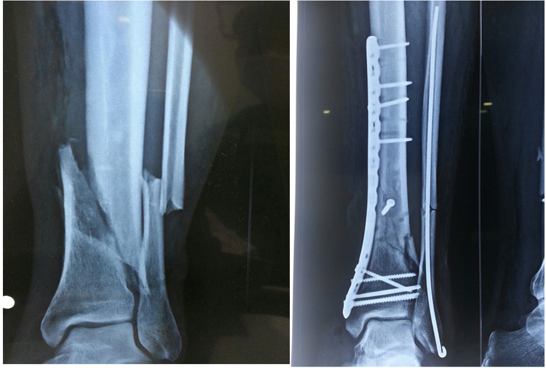 Complex fracture surgery case 14