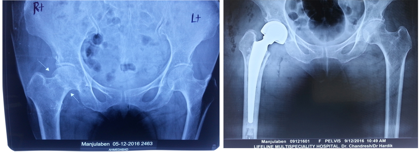 Complex fracture surgery case 4