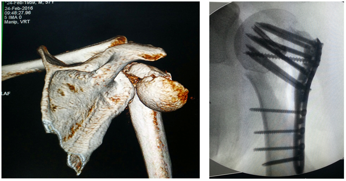 Complex fracture surgery case 5
