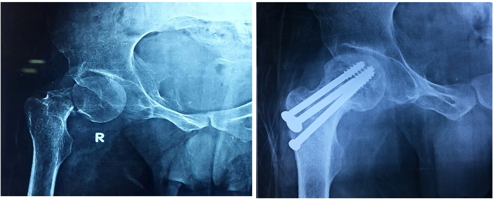 Complex fracture surgery case 6