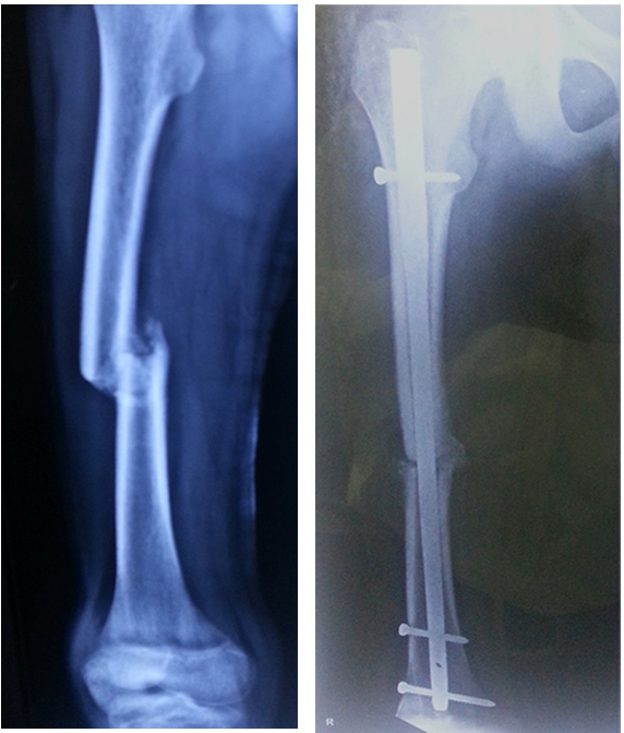 Complex fracture surgery case 7