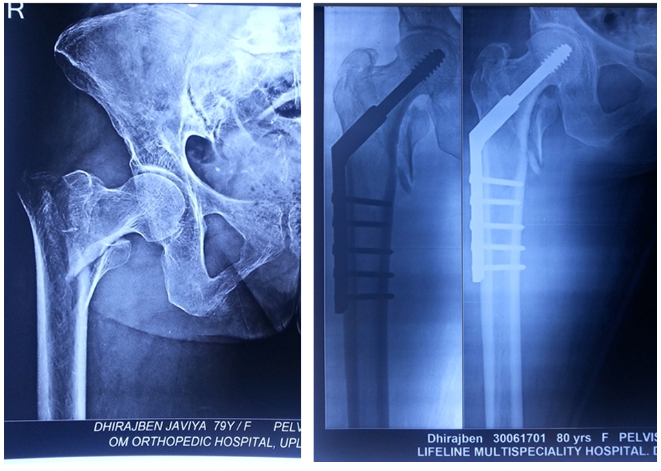 Complex fracture surgery case 8