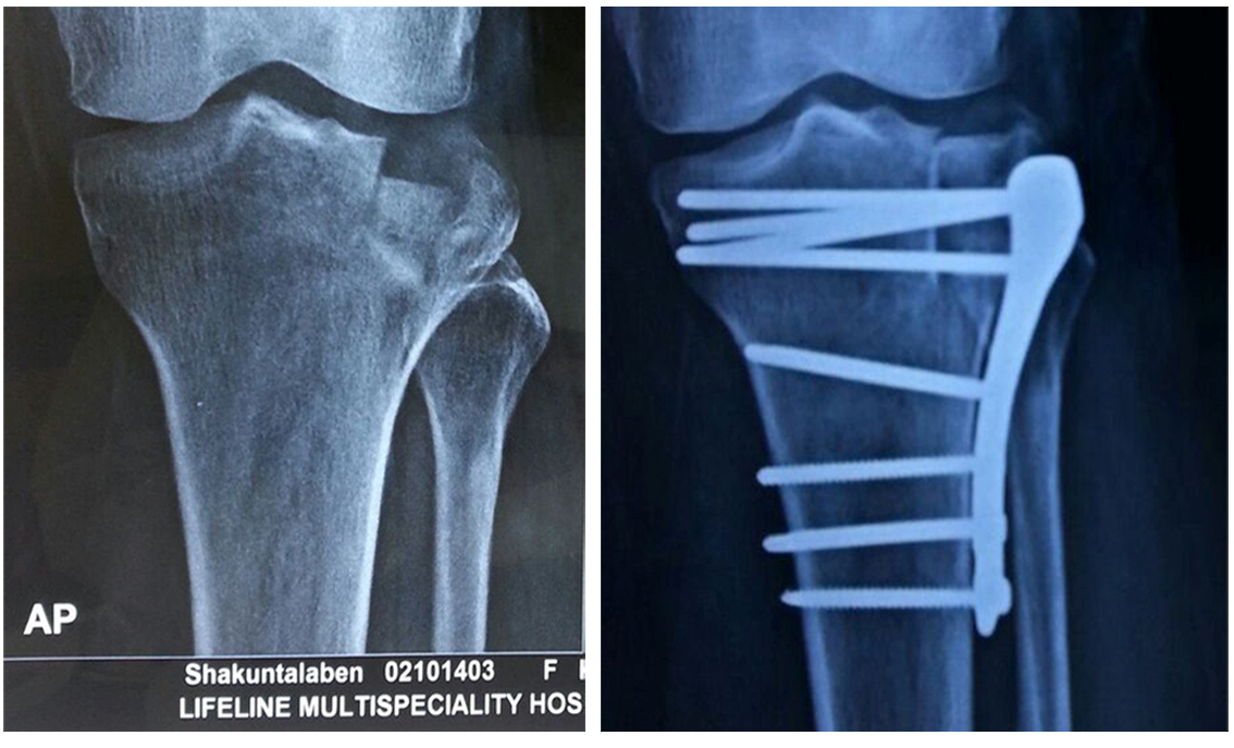 Complex fracture surgery case 9