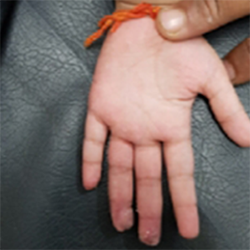 Case 1: Crush Finger Injury In Child, photo 5