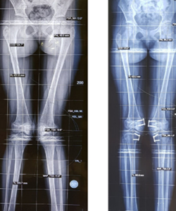 Case 3: Twisted Feet Correction, photo 1