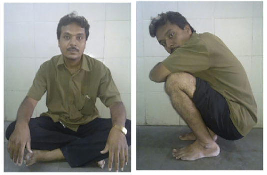 Bilateral hip replacement, treated case 11