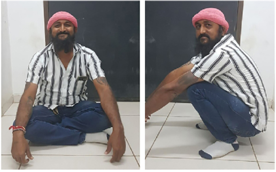 Hip replacement, treated case 12