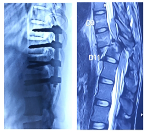 Spine surgery, treated case 6