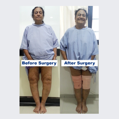 Knee replacement case