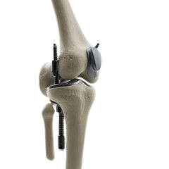 Joint Replacement